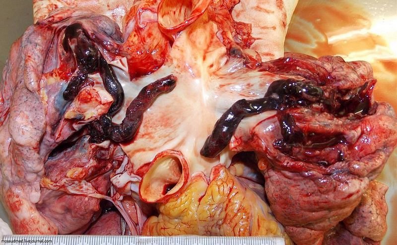Тромбы не могут преодолеть легочные артерии и закупоривают их, лишая человека возможности дышать - фото 56 из книги «Вскрытие покажет»