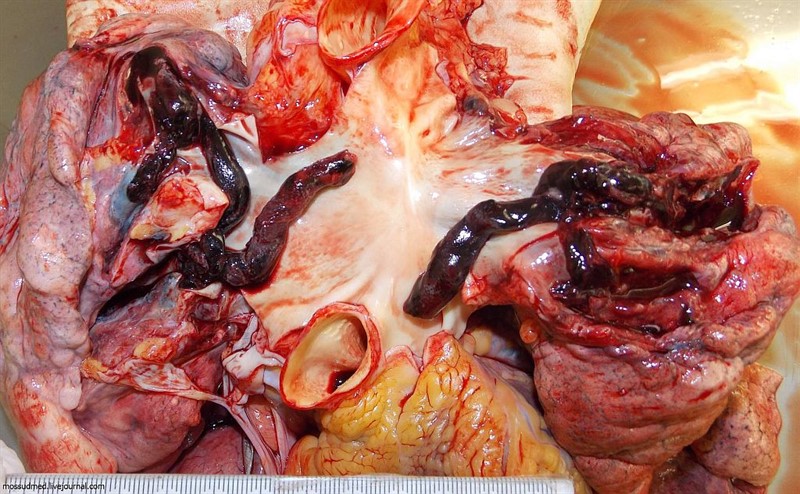 Тромбы не могут преодолеть легочные артерии и закупоривают их, лишая человека возможности дышать ч.2 - фото 99 из книги «Вскрытие покажет»