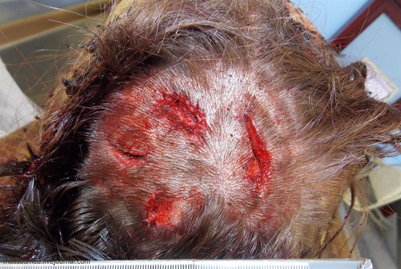 Бытовой конфликт: раны на голове от ударов молотком - фото 45 из книги «Вскрытие покажет»