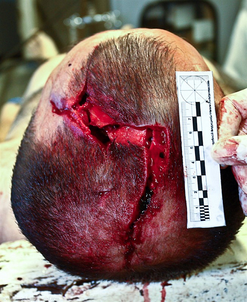 Причина смерти – черепно-мозговая травма от падения ветки тополя ч.1 - фото 47 из книги «Вскрытие покажет»