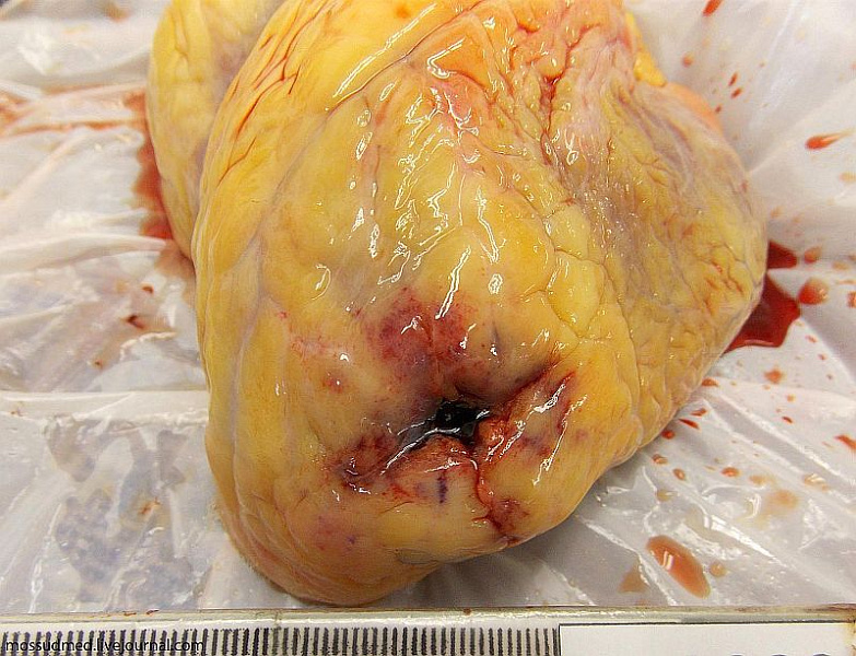 Ранения груди из травматического пистолета «Оса»: ранение сердца - фото 20 из книги «Вскрытие покажет»