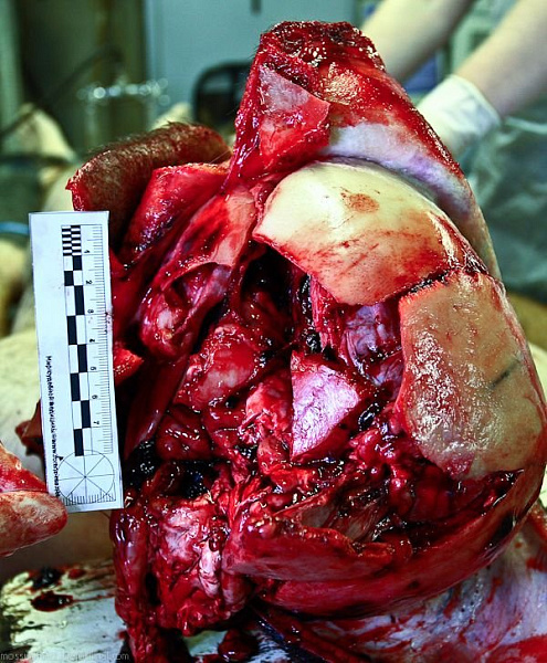 Причина смерти – черепно-мозговая травма от падения ветки тополя - фото 18 из книги «Вскрытие покажет»