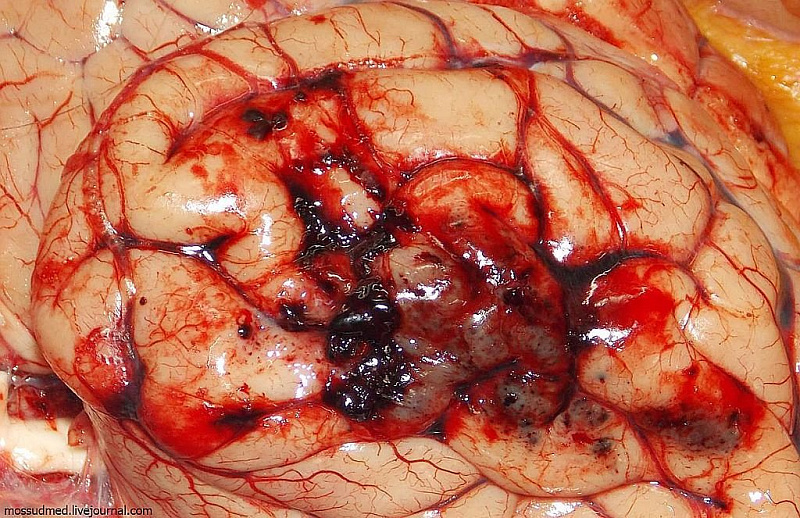 Результат прыжка с 5-го этажа: кровоизлияния под мягкую мозговую оболочку и ушиб головного мозга - фото 13 из книги «Вскрытие покажет»