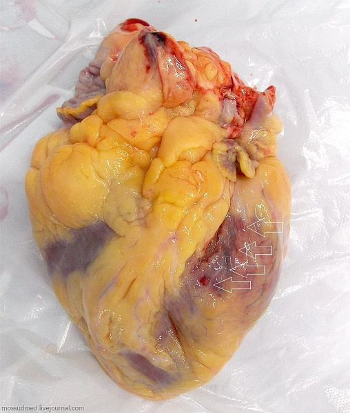 Иногда при инфаркте миокарда кровь выливается в перикард, сдавливая сердце, что и приводит к смерти - фото 50 из книги «Вскрытие покажет»