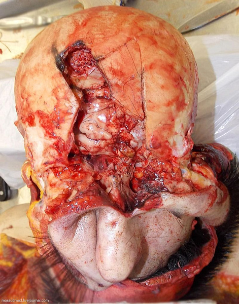Открытая черепно-мозговая травма - фото 9 из книги «Вскрытие покажет»