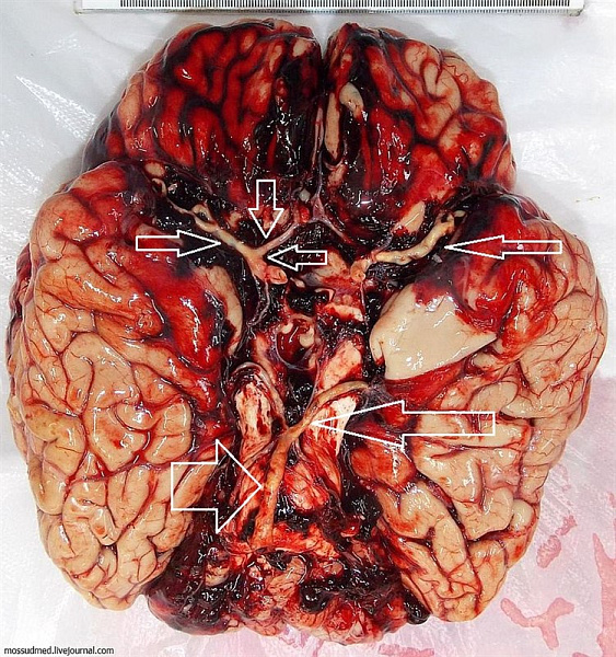 Артерии, пораженные атеросклерозом - фото 96 из книги «Вскрытие покажет»