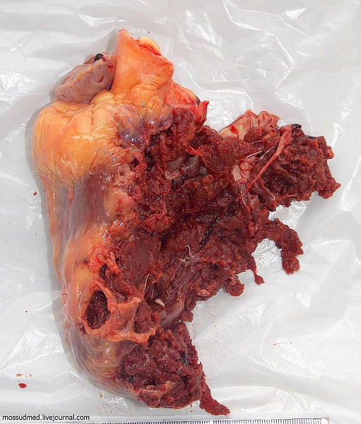 Ранение сердца, причиненное выстрелом из дробового ружья в грудь - фото 23 из книги «Вскрытие покажет»