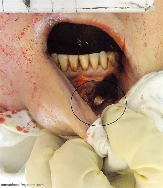 При ранении теменно-затылочной области головы пуля может оказаться в преддверии рта ч.2 - фото 62 из книги «Вскрытие покажет»