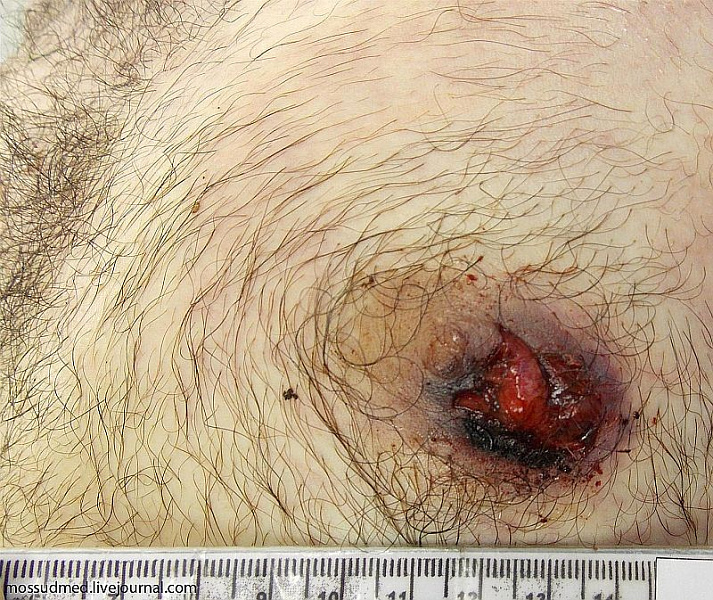 Ранения груди из травматического пистолета «Оса»: входная рана на груди - фото 56 из книги «Вскрытие покажет»