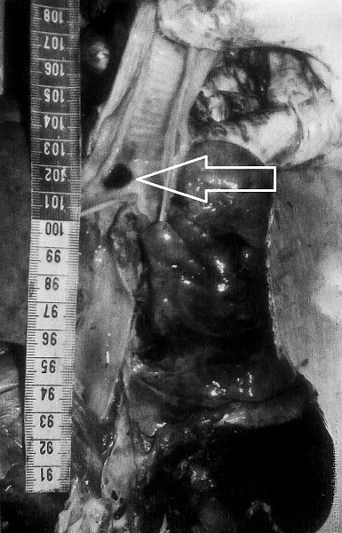 Неочищенная семечка, застрявшая в трахее - фото 35 из книги «Вскрытие покажет»