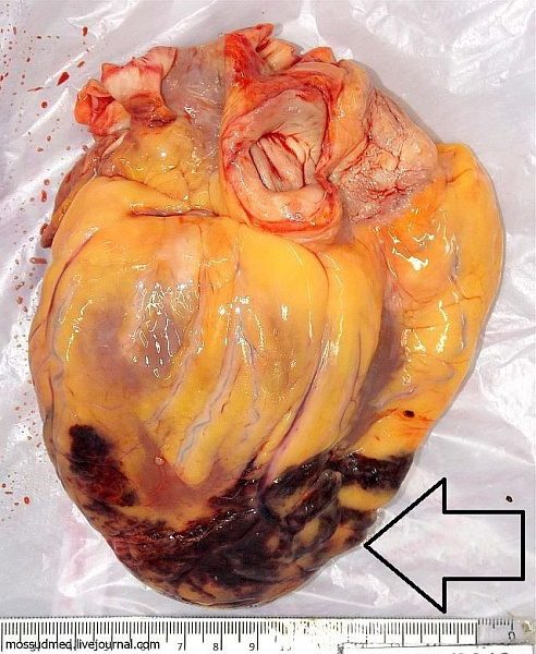 При внутреннем исследовании инфаркт миокарда на разных стадиях своего развития: кровоизлияния, которые пропитывают мышцу сердца - фото 51 из книги «Вскрытие покажет»